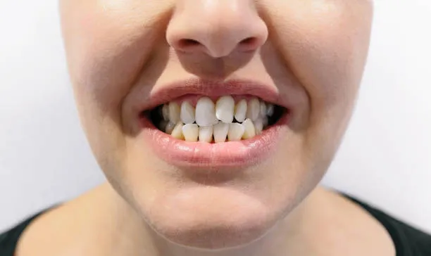 Sonrisa con dientes apiñados antes del tratamiento