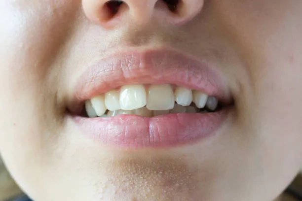 Dientes desalineados antes del diseño de sonrisa